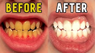 How I Whitened My Teeth in 14 Days [upl. by Eniruam]