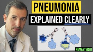 Pneumonia Explained Symptoms Diagnosis Labs Treatment [upl. by Arais]