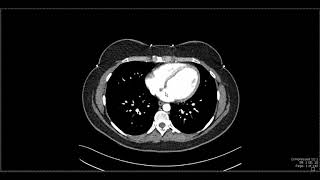 Abdominal Anatomy on Computed Tomography [upl. by Anaujahs944]