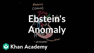 Ebsteins anomaly  Circulatory System and Disease  NCLEXRN  Khan Academy [upl. by Malet]