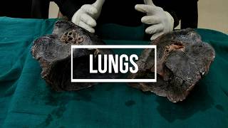 Lungs  gross anatomy [upl. by Aitan]