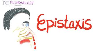 Epistaxis nosebleed Causes and Management [upl. by Nathaniel558]