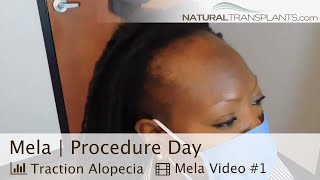 Hair Transplant Forehead Reduction Procedure for Traction Alopecia  Dr Matt Huebner Mela [upl. by Veator]