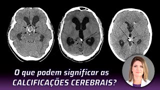 O QUE PODEM SIGNIFICAR AS CALCIFICAÇÕES CEREBRAIS [upl. by Nikolia]