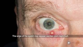 Are styes contagious and what can I do about them  Ask an Ophthalmologist [upl. by Annoerb]