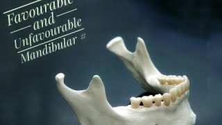 Mandibular Fractures  Favourable and Unfavourable [upl. by Josias227]