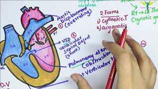 Ventricular Septal Defect VSD  Heart Auscultation  Episode 11 [upl. by Lepper]