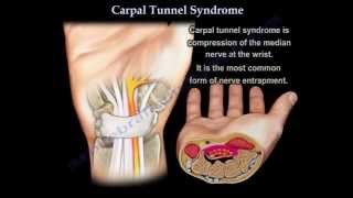 Carpal Tunnel Syndrome  Everything You Need To Know  Dr Nabil Ebraheim [upl. by Cerys]