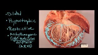 Hypertrophic Cardiomyopathy HCM Innovative Options for Treatment [upl. by Niamor]