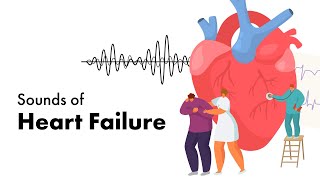 Ventricular Septal Defect VSD  Heart Auscultation  Episode 11 [upl. by Pachton]