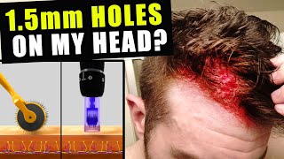 I Cut Thousands Of 15 Millimetre Holes In My Head Every Week To Prevent Hair Loss [upl. by Ahsed]