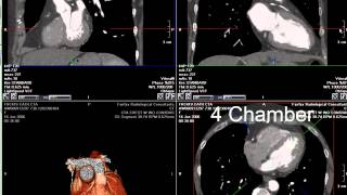 Coronary CT Angiography RCA Stenosis [upl. by Mizuki]