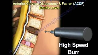 Cervical Spine Decompression And Fusion   Everything You Need To Know  Dr Nabil Ebraheim [upl. by Atkinson654]