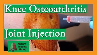 Knee Osteoarthritis Steroid Joint Injection Treatment  Auburn Medical Group [upl. by Dnalwor566]