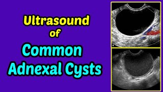 Fibromas uterinos  Síntomas y tratamiento [upl. by Nnelg]