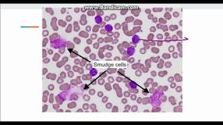 Chronic Lymphocytic Leukemia CLL [upl. by Rakia]