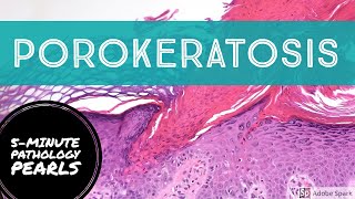 Porokeratosis 5Minute Pathology Pearls [upl. by Aile706]