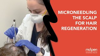 MicroNeedling the Scalp for Hair Regeneration [upl. by Noivad39]