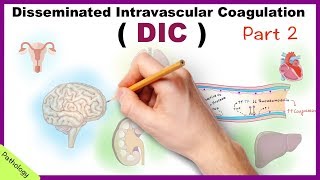 DIC Disseminated Intravascular Coagulation  Part 2 [upl. by Singhal371]