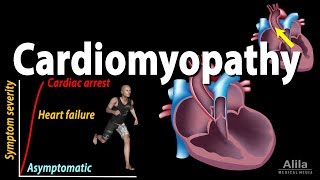 Cardiomyopathy animation [upl. by Yerffoeg]