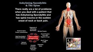 Ankylosing Spondylitis amp The Spine  Everything You Need To Know  Dr Nabil Ebraheim [upl. by Notsirk]