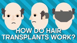 How Do Hair Transplants Work  Earth Science [upl. by Ingalls]