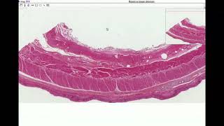 2020 UPDATE Bad Chest Pain Esophageal Spasm [upl. by Arva502]