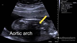 ROUND LIGAMENT PAIN  GROIN PAIN DURING PREGNANCY [upl. by Nivri]