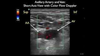 How To Axillary Vein Cannulation  Sonosite Ultrasoundmp4 [upl. by Ramin]